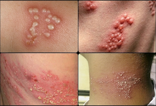 Illustration for article titled cara menghilangkan nyeri akibat herpes